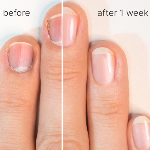 How can cuticle oil help with specific nail problems
